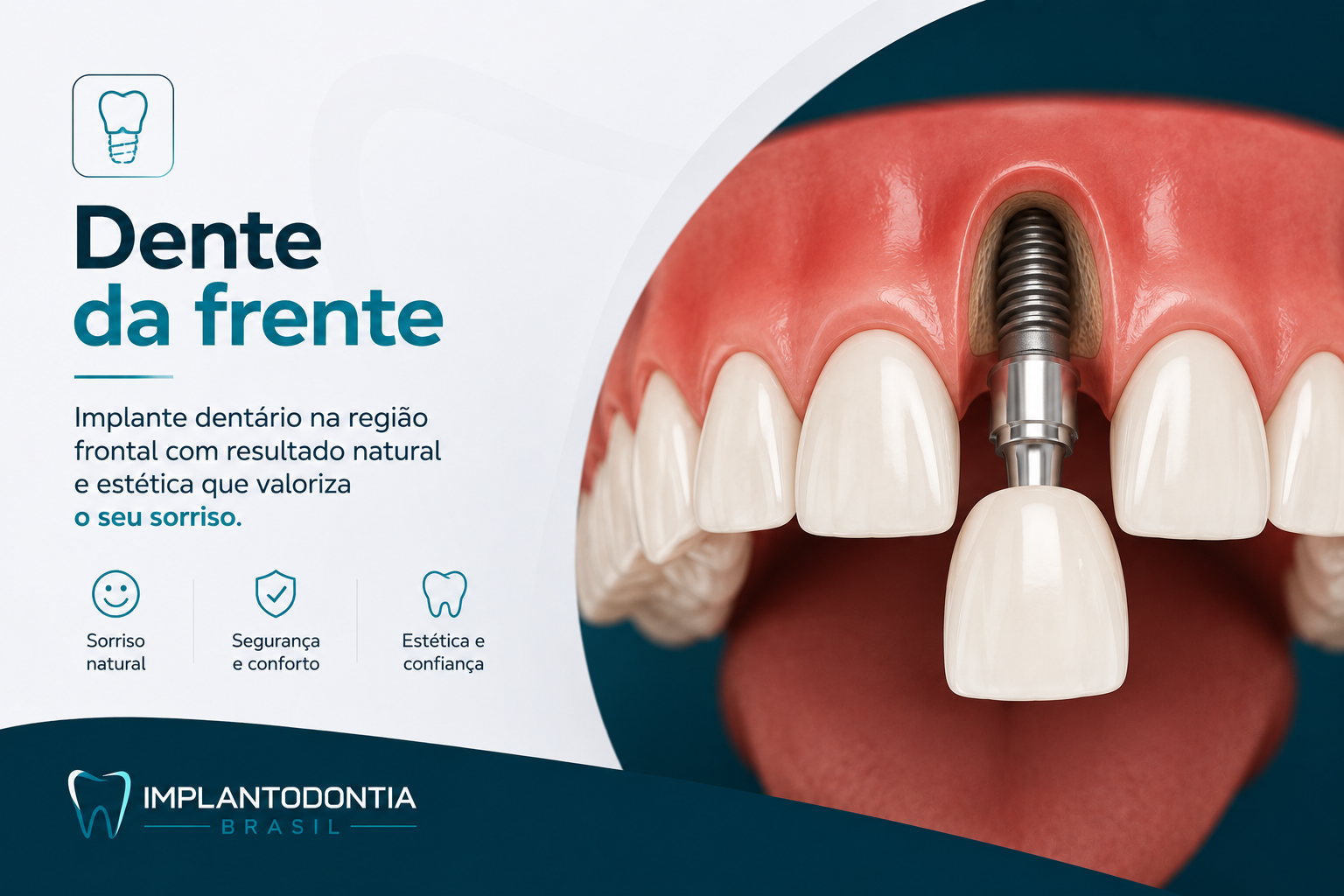 Implantes Dentários