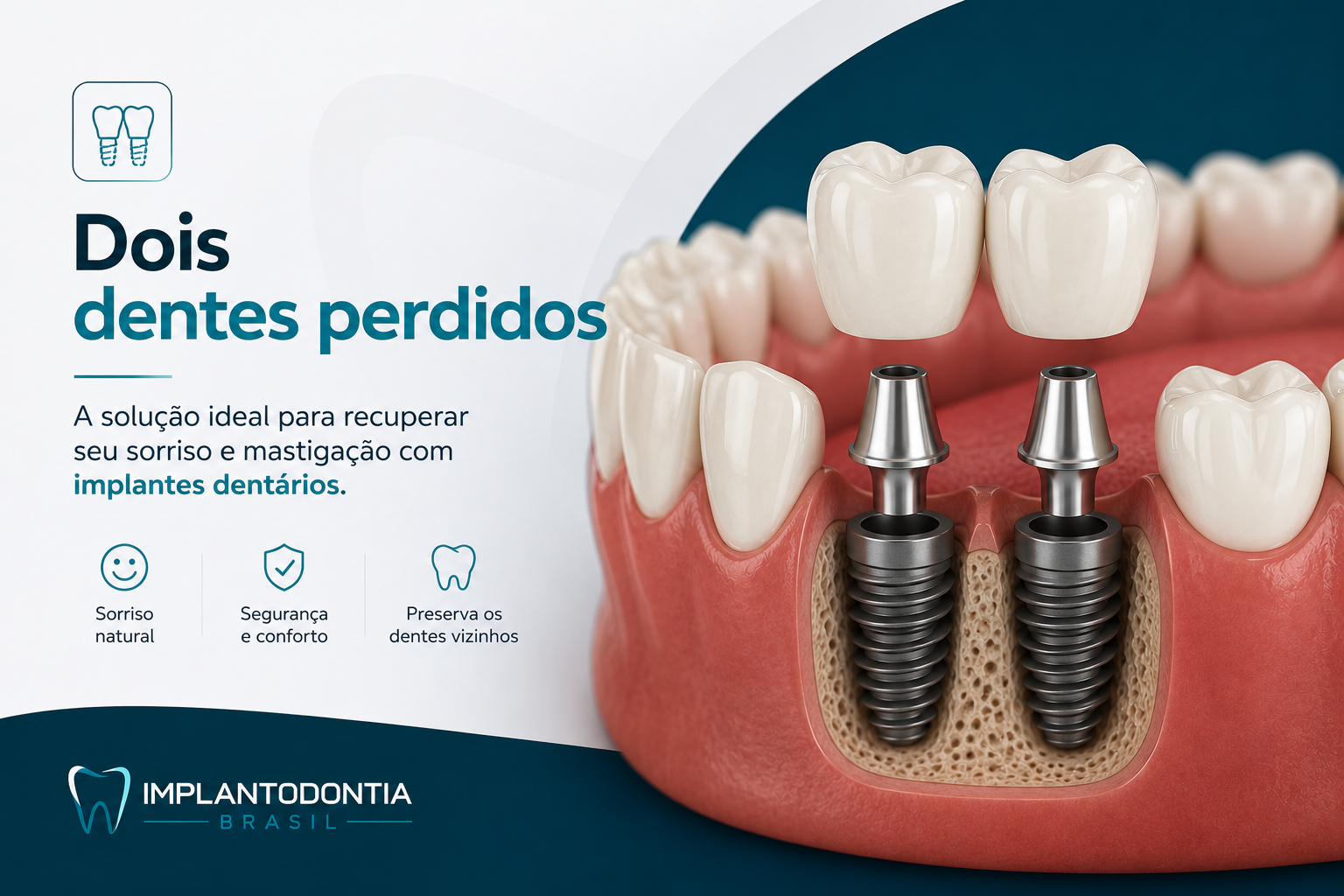 Implantes Dentários