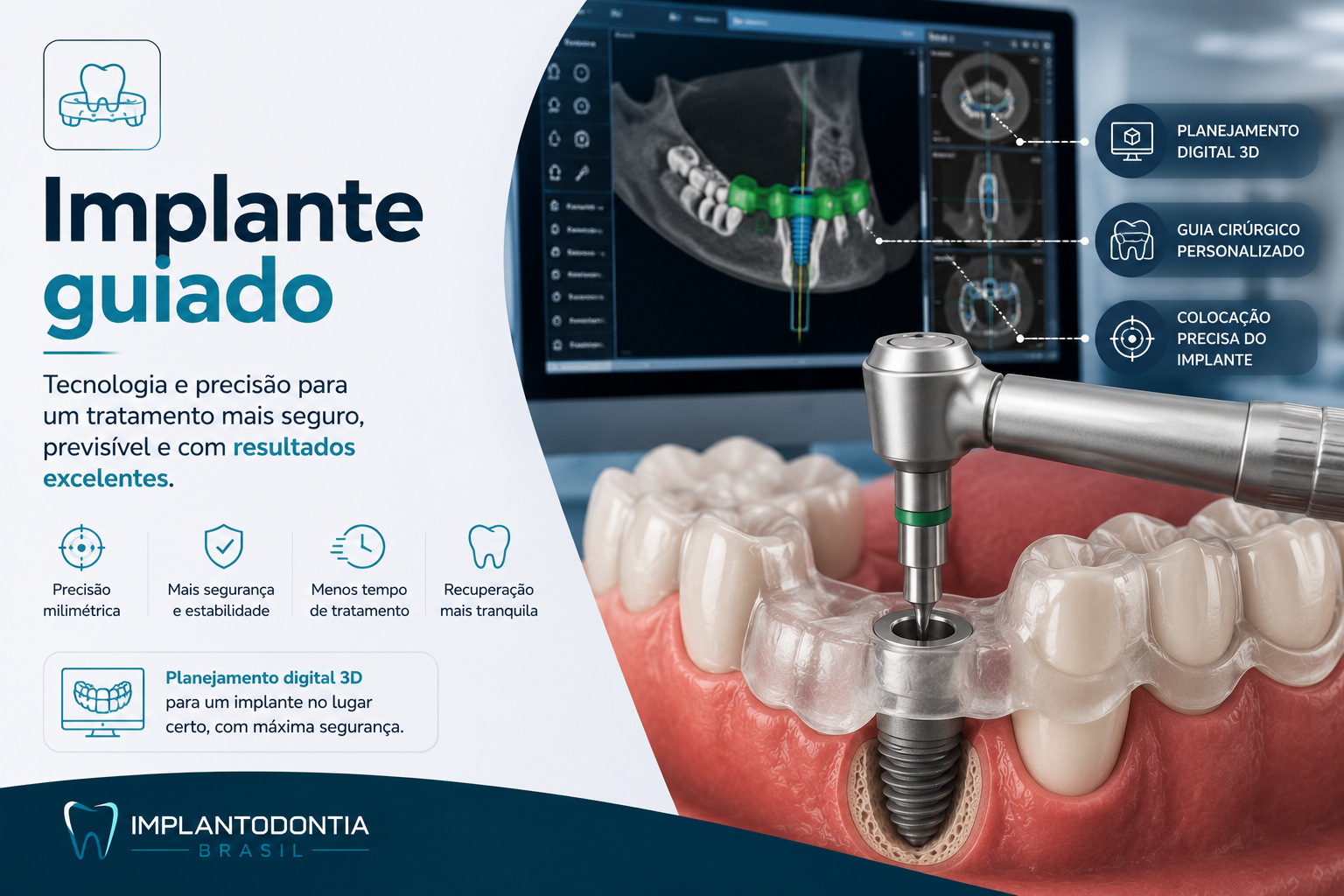 Implantes Dentários