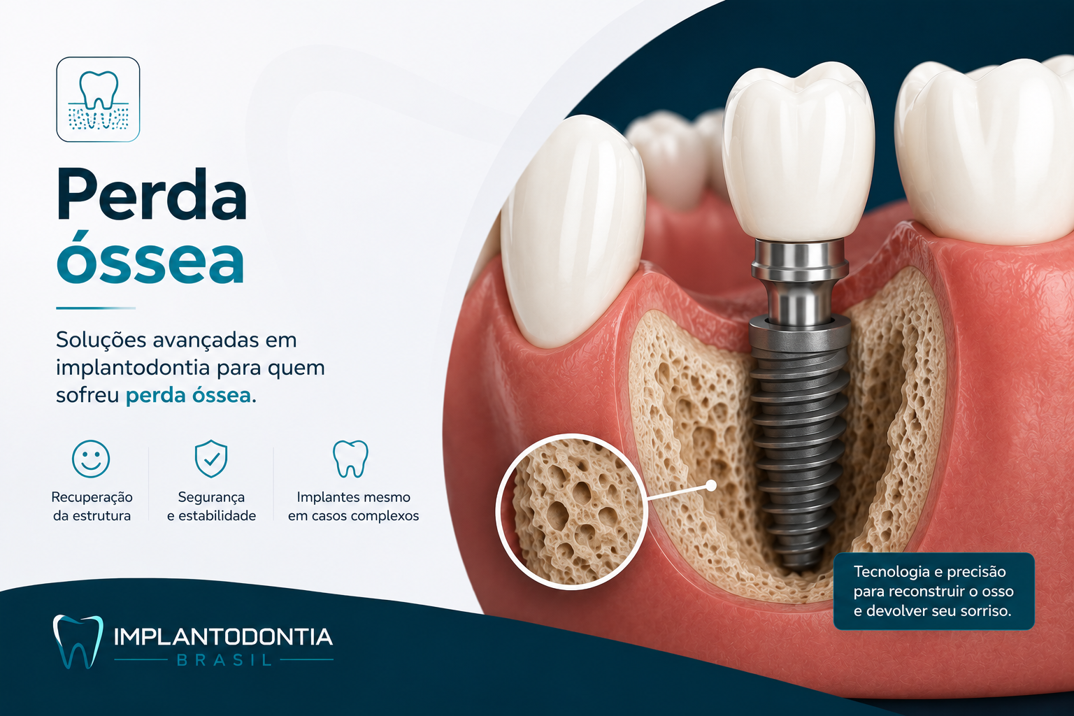 Implantes Dentários