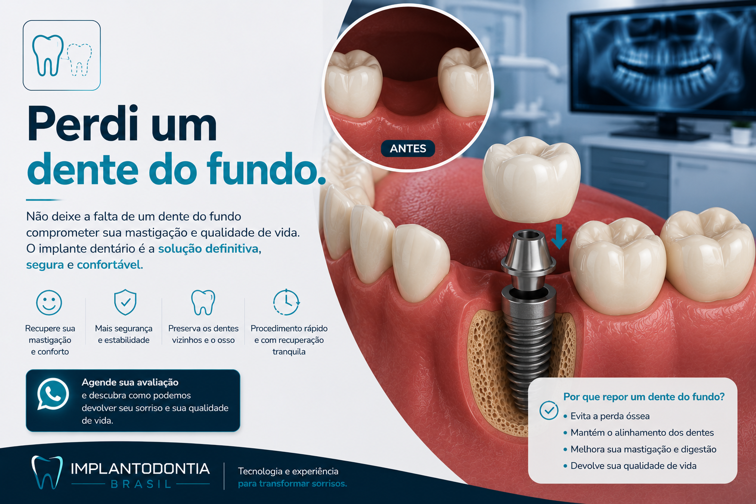 Implante dentário unitário