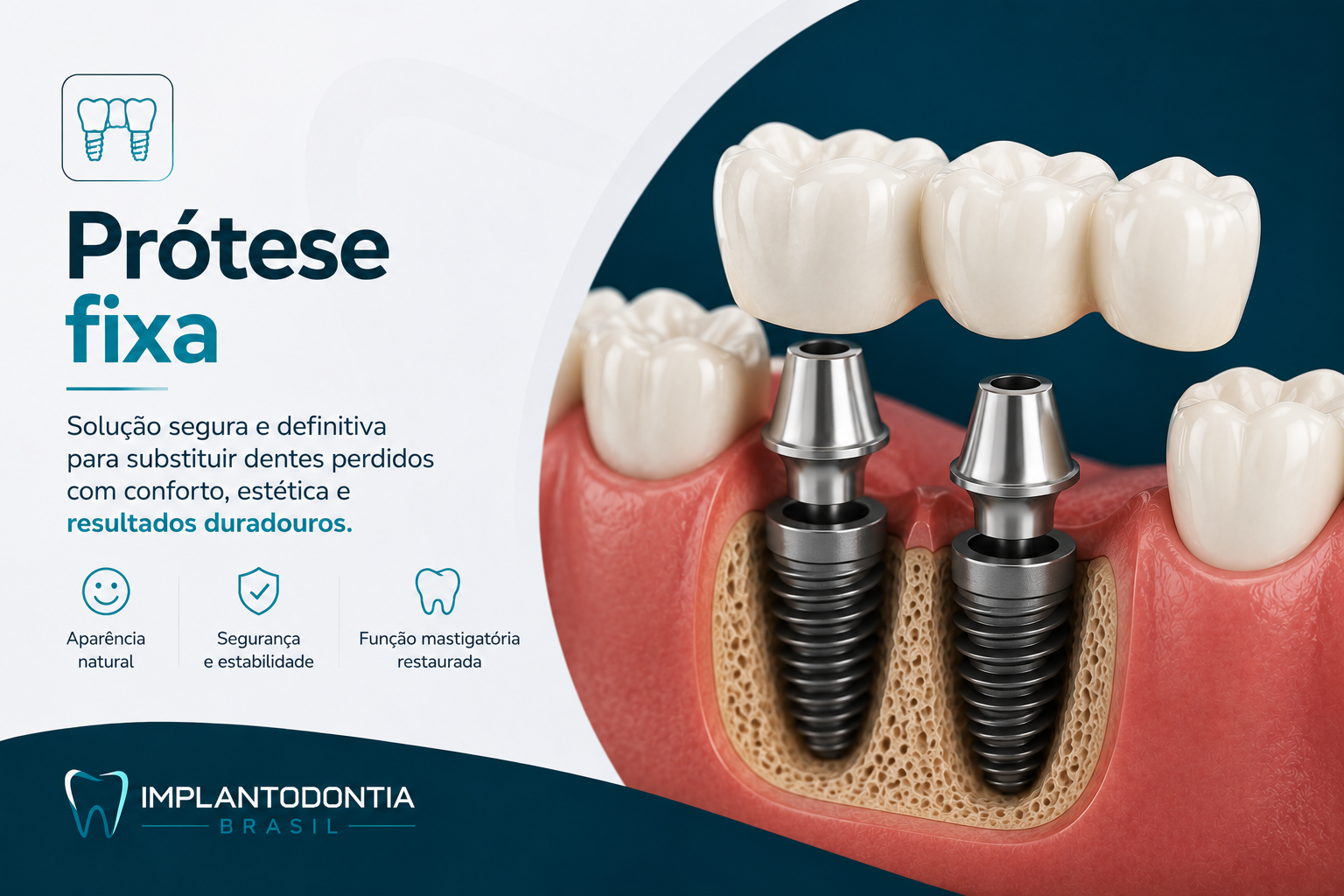 Implantes Dentários