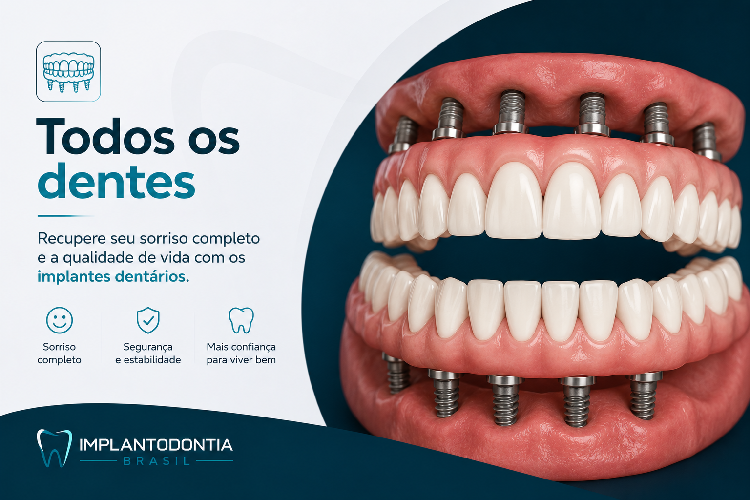 Implantes Dentários