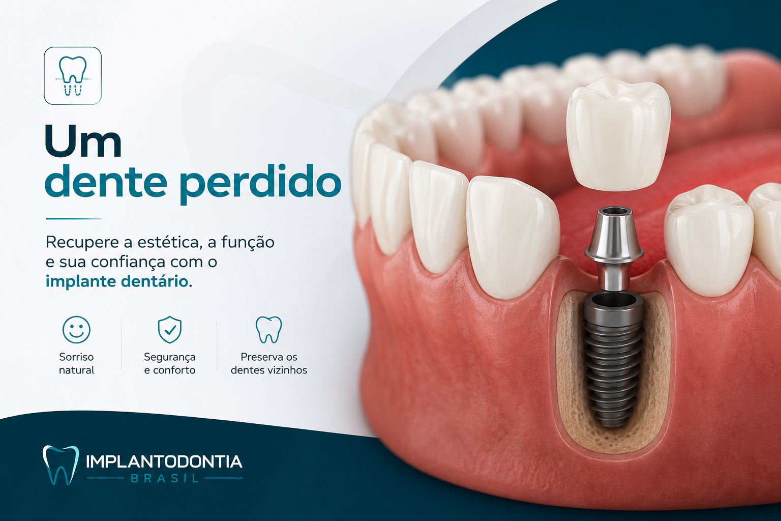 Implantes Dentários
