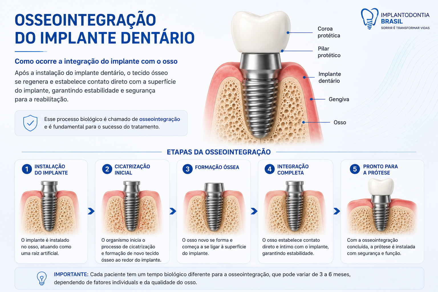Ilustração da Osseointegração do implante dentário