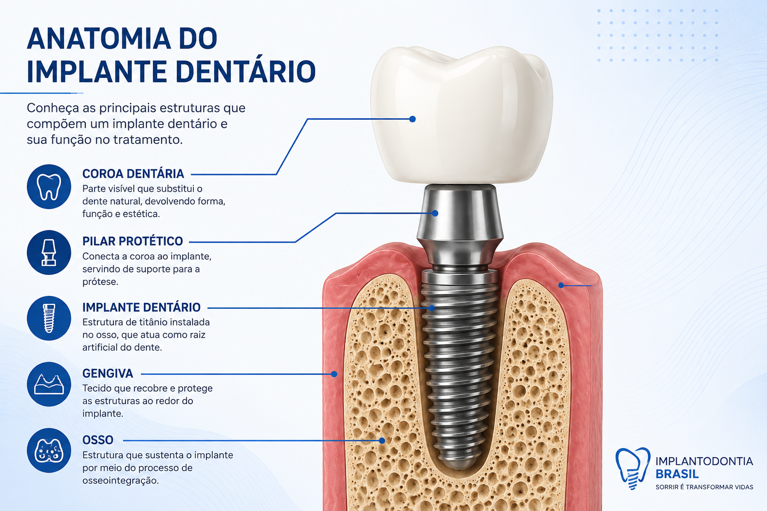 Anatomia de um implante dentário mostrando coroa, pilar protético, implante, gengiva e osso