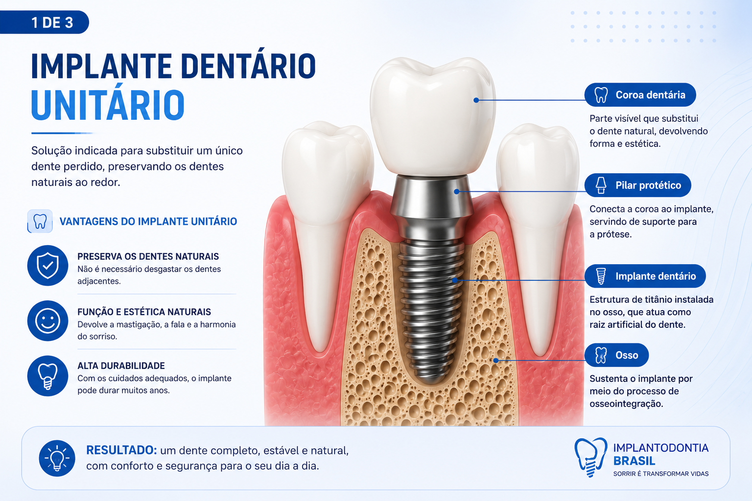 Prótese protocolo sustentada por implantes para reabilitação da arcada dentária