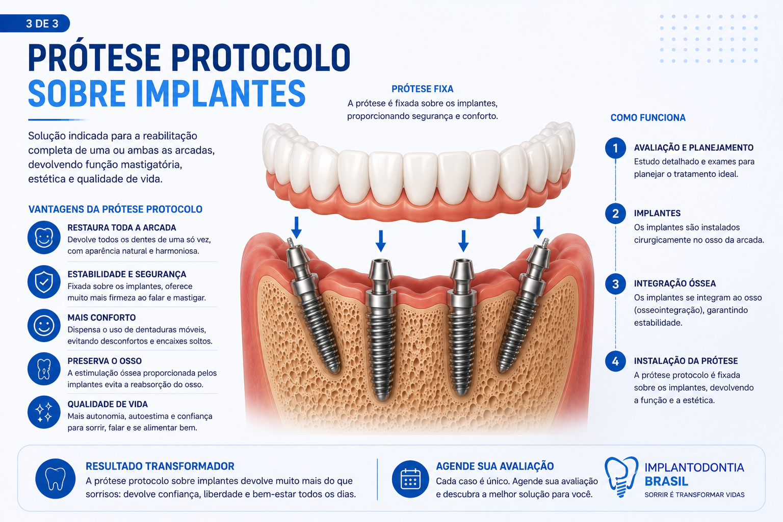 Ilustração de implante dentário unitário substituindo um único dente