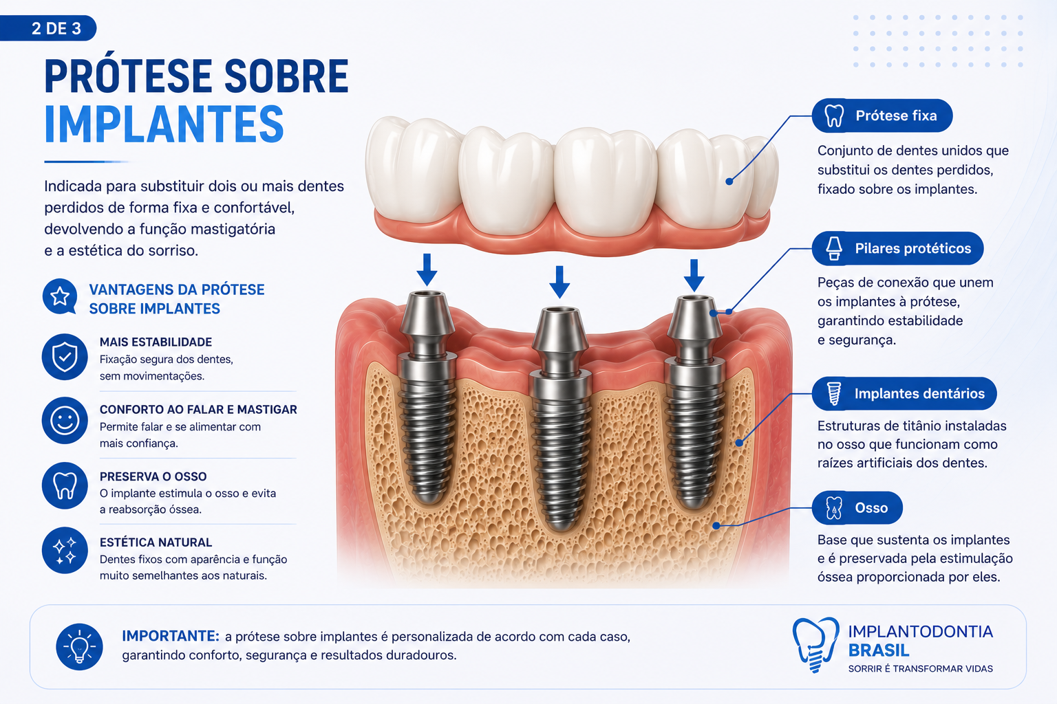 Prótese fixa sobre implantes utilizada na reabilitação de vários dentes