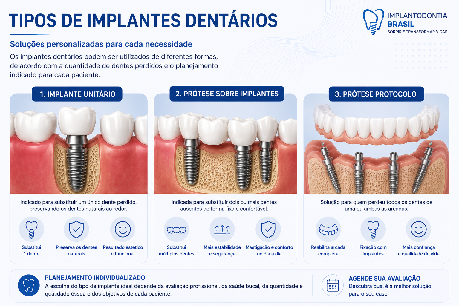 Tipos de implantes dentários, implante unitário, prótese sobre implantes e prótese protocolo